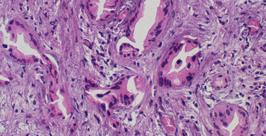 Cholangiocarcinoma