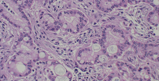 Cholangiocarcinoma