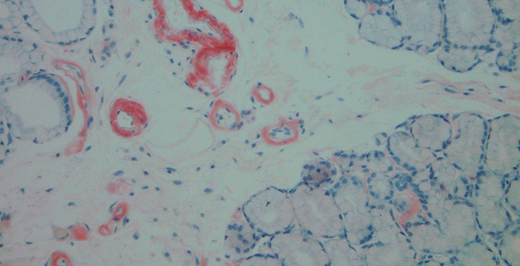Congo Red Positive Amyloid Deposits in the GI Tract